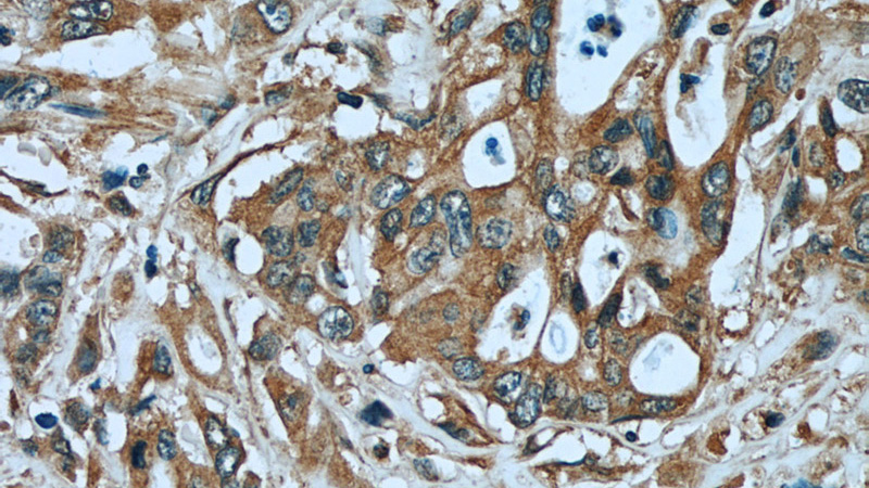 Immunohistochemistry of paraffin-embedded human stomach cancer tissue slide using Catalog No:107234(KRT8 Antibody) at dilution of 1:50 (under 40x lens)