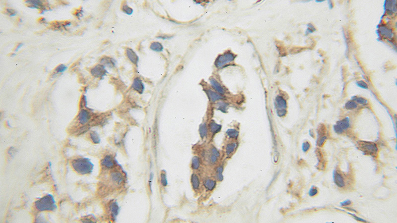 Immunohistochemical of paraffin-embedded human prostate cancer using Catalog No:109546(CREB3 antibody) at dilution of 1:100 (under 25x lens)