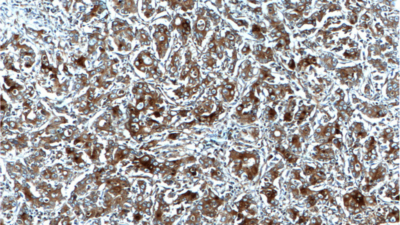 Immunohistochemistry of paraffin-embedded human stomach cancer tissue slide using Catalog No:113507(OPN, SPP1 Antibody) at dilution of 1:200 (under 10x lens).