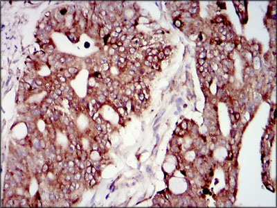 Immunohistochemical analysis of paraffin-embedded rectum cancer tissues using PIK3R1 mouse mAb with DAB staining.