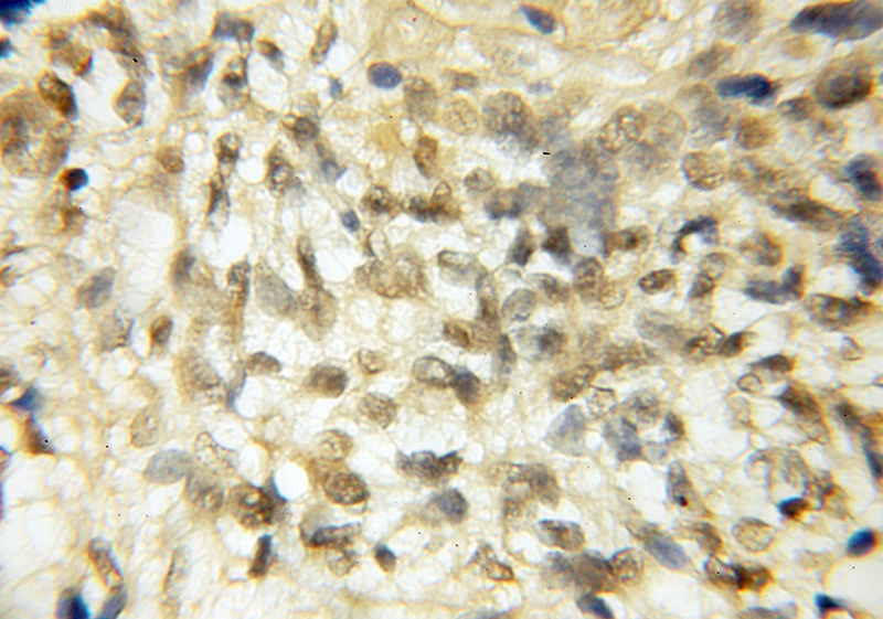 Immunohistochemical of paraffin-embedded human gliomas using Catalog No:114774(ROBO3 antibody) at dilution of 1:50 (under 10x lens)
