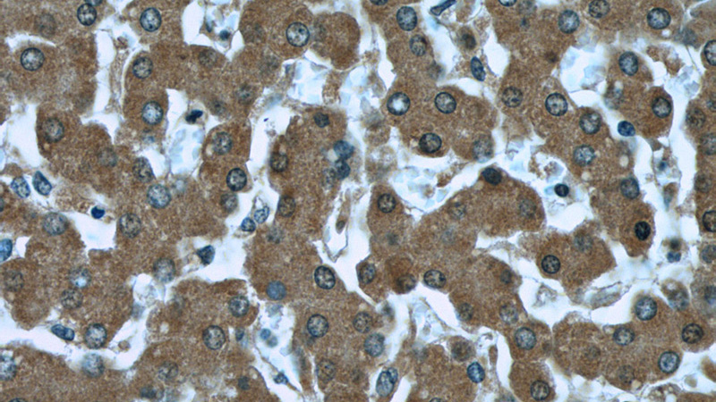 Immunohistochemistry of paraffin-embedded human liver tissue slide using Catalog No:107483(TTR Antibody) at dilution of 1:50
