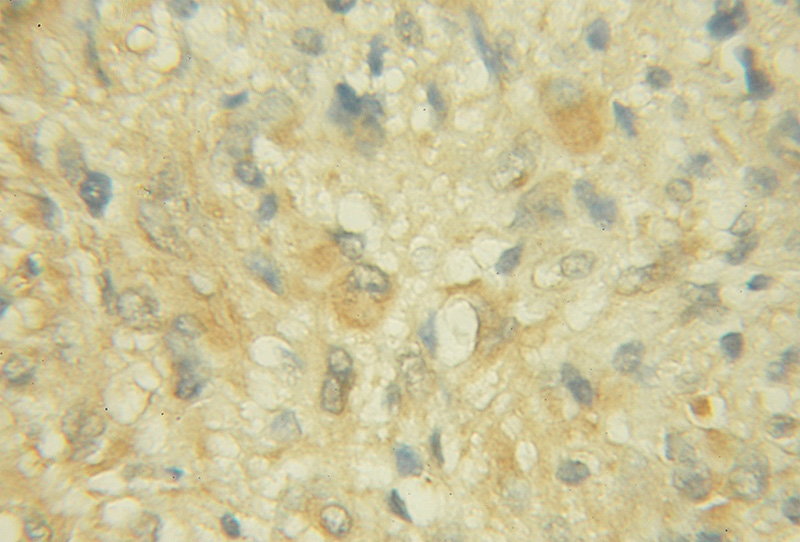 Immunohistochemical of paraffin-embedded human gliomas using Catalog No:109291(CHST10 antibody) at dilution of 1:50 (under 10x lens)