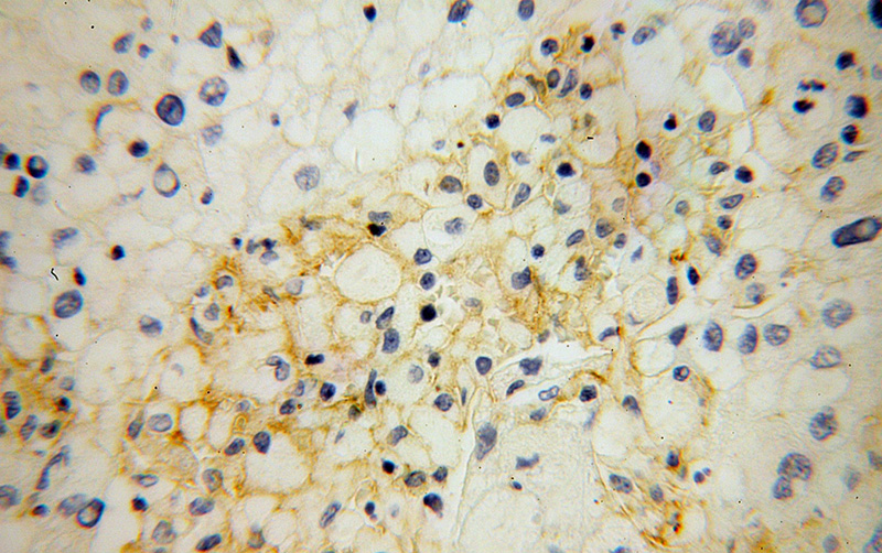 Immunohistochemical of paraffin-embedded human liver cancer using Catalog No:115227(SIGLEC9 antibody) at dilution of 1:100 (under 40x lens)