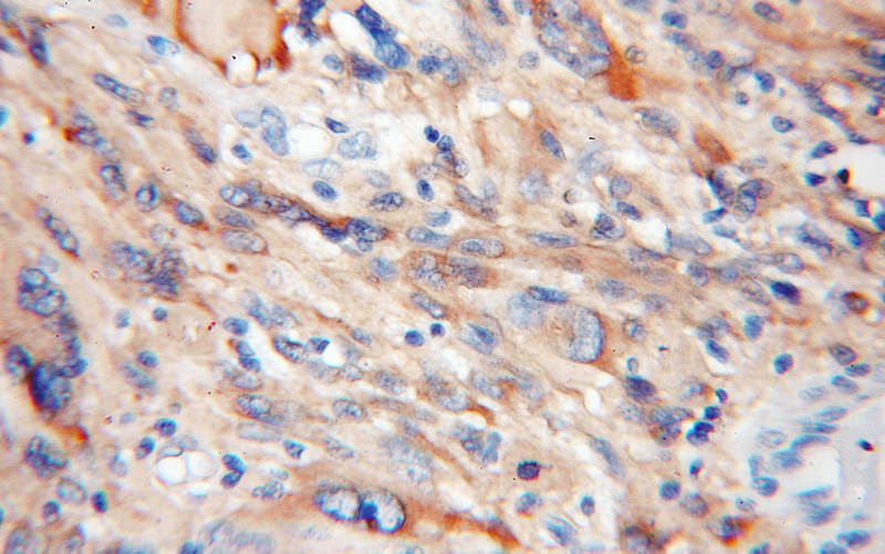 Immunohistochemical of paraffin-embedded human gliomas using Catalog No:110174(EIF1AX antibody) at dilution of 1:50 (under 10x lens)