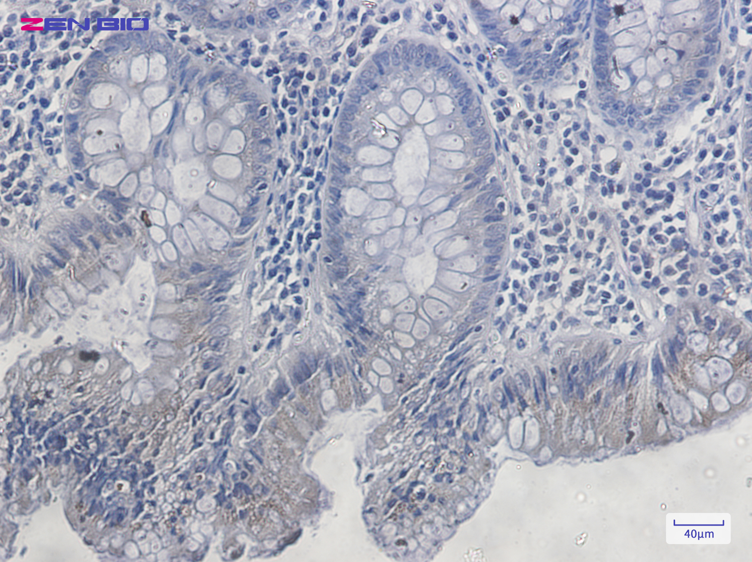 Immunohistochemistry of PDPK1 in paraffin-embedded Human colon cancer tissue using PDPK1 Rabbit pAb at dilution 1/20