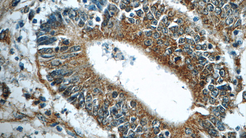 Immunohistochemistry of paraffin-embedded human colon cancer tissue slide using Catalog No:111352(HIP1 Antibody) at dilution of 1:50 (under 40x lens)