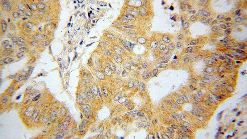 Immunohistochemical of paraffin-embedded human colon cancer using Catalog No:116570(UMPS antibody) at dilution of 1:100 (under 40x lens)