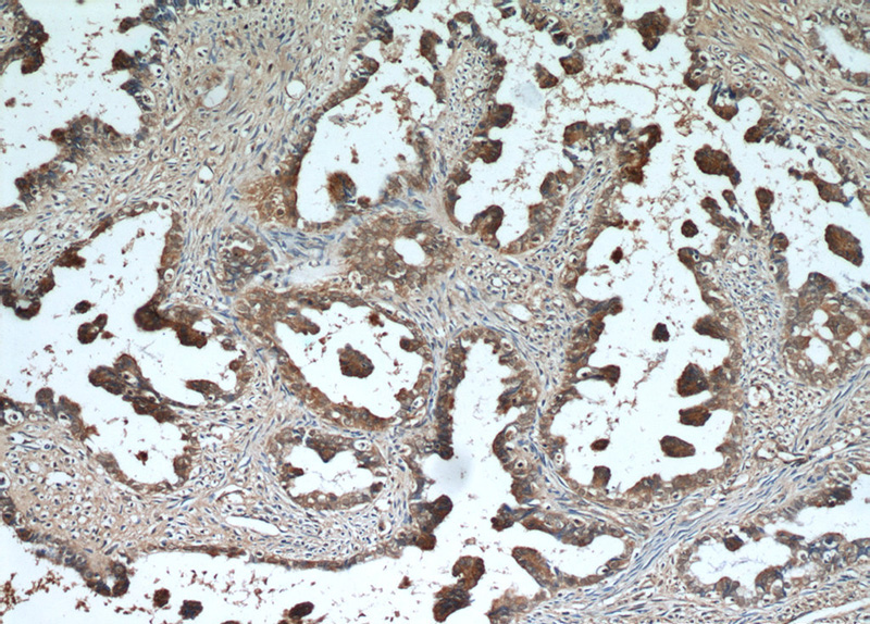 Immunohistochemical of paraffin-embedded human ovary tumor using Catalog No:107991(AMH antibody) at dilution of 1:25 (under 10x lens)