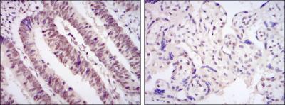 Immunohistochemical analysis of paraffin-embedded rectum cancer tissues (left) and placenta tissues (right) using CDK9 mouse mAb with DAB staining.