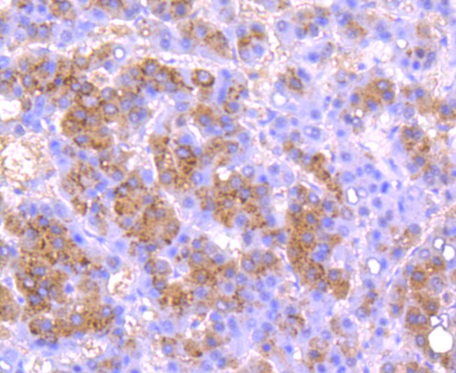 Fig2:; Immunohistochemical analysis of paraffin-embedded human liver carcinoma tissue using anti-Urokinase antibody. The section was pre-treated using heat mediated antigen retrieval with Tris-EDTA buffer (pH 8.0-8.4) for 20 minutes.The tissues were blocked in 5% BSA for 30 minutes at room temperature, washed with ddH; 2; O and PBS, and then probed with the primary antibody ( 1/50) for 30 minutes at room temperature. The detection was performed using an HRP conjugated compact polymer system. DAB was used as the chromogen. Tissues were counterstained with hematoxylin and mounted with DPX.