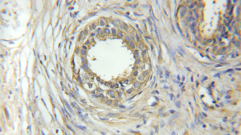 Immunohistochemical of paraffin-embedded human prostate cancer using Catalog No:113426(ORM2 antibody) at dilution of 1:50 (under 10x lens)
