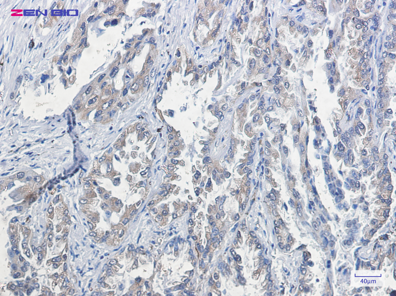 Immunohistochemistry of RAP1GAP in paraffin-embedded Human lung cancer tissue using RAP1GAP Rabbit pAb at dilution 1/50
