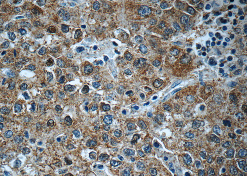 Immunohistochemistry of paraffin-embedded human liver cancer tissue slide using Catalog No:114117(PPP4R2 Antibody) at dilution of 1:50 (under 40x lens)