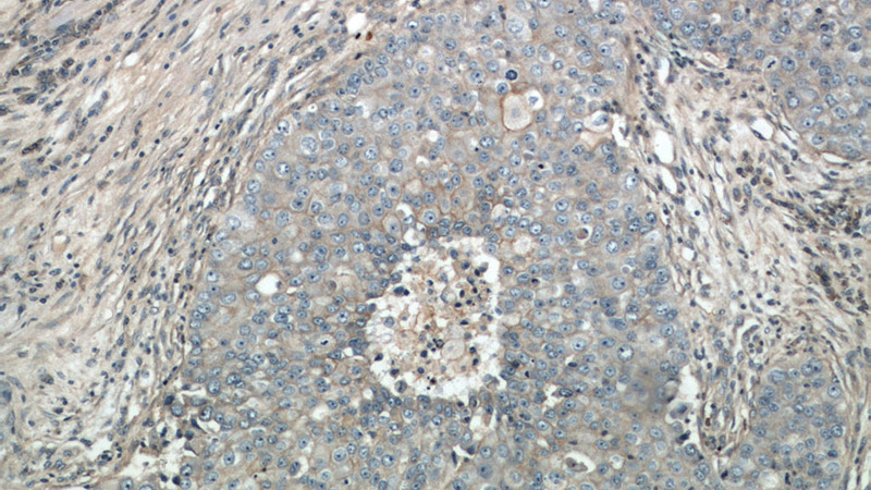 Immunohistochemical of paraffin-embedded human breast cancer using Catalog No:111076(SLC2A1,GLUT1 antibody) at dilution of 1:50 (under 10x lens)