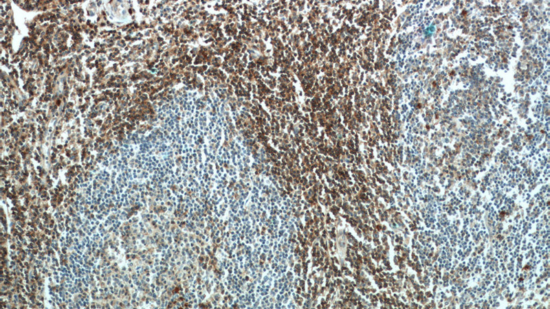 Immunohistochemical of paraffin-embedded human tonsillitis using Catalog No:109021(CD3G antibody) at dilution of 1:50 (under 10x lens)