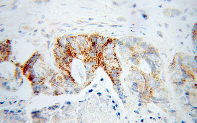 Immunohistochemical of paraffin-embedded human liver cancer using Catalog No:109567(CRLS1-Specific antibody) at dilution of 1:50 (under 40x lens)