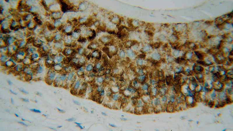 Immunohistochemical of paraffin-embedded human skin cancer using Catalog No:113926(PLA2G4D antibody) at dilution of 1:50 (under 40x lens)