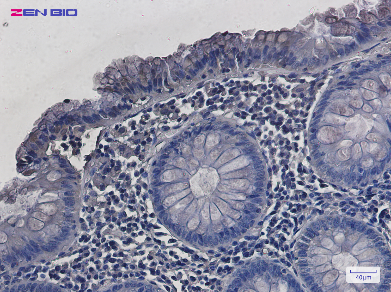 Immunohistochemistry of SDHA in paraffin-embedded Human colon cancer tissue using SDHA Rabbit pAb at dilution 1/20