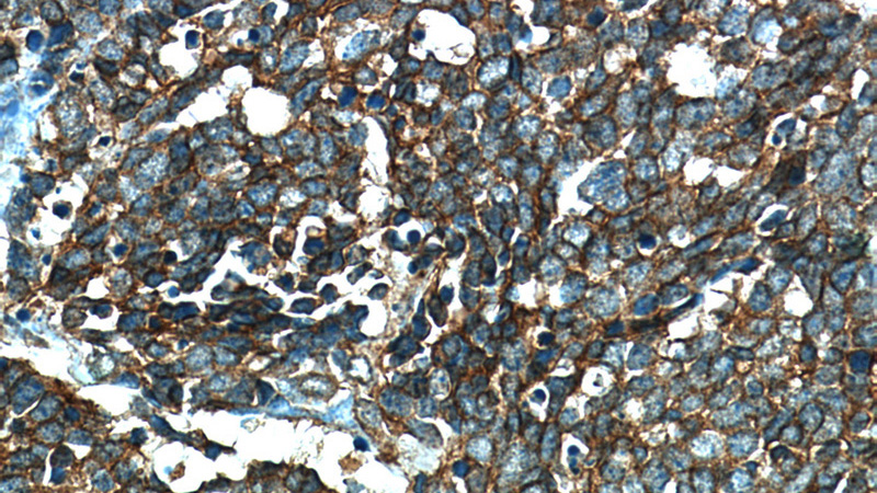 Immunohistochemical of paraffin-embedded human lung cancer using Catalog No:107324(NCAM1 antibody) at dilution of 1:50 (under 40x lens)
