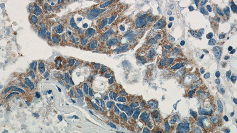 Immunohistochemistry of paraffin-embedded human breast cancer tissue slide using Catalog No:112645(MAP2K4 Antibody) at dilution of 1:50 (under 40x lens)