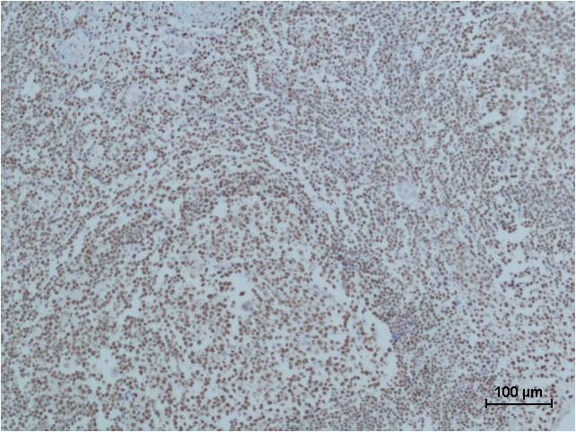 Immunohistochemical analysis of paraffin-embedded human Tonsil Tissue using Cleaved PARP uff08uff09Mouse mAb diluted at 1:500.