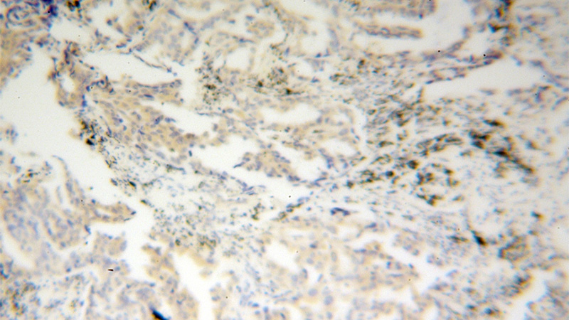 Immunohistochemical of paraffin-embedded human lung cancer using Catalog No:109301(CHSY1 antibody) at dilution of 1:100 (under 10x lens)
