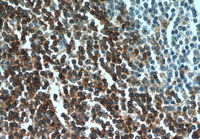 Immunohistochemical of paraffin-embedded human tonsillitis using Catalog No:109021(CD3G antibody) at dilution of 1:50 (under 40x lens)