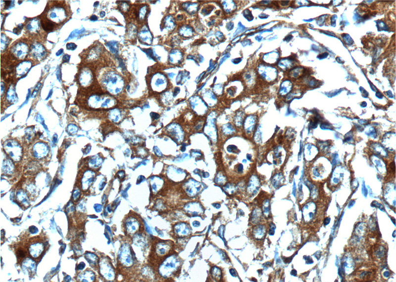 Immunohistochemistry of paraffin-embedded human stomach cancer tissue slide using Catalog No:113507(OPN, SPP1 Antibody) at dilution of 1:200 (under 40x lens).