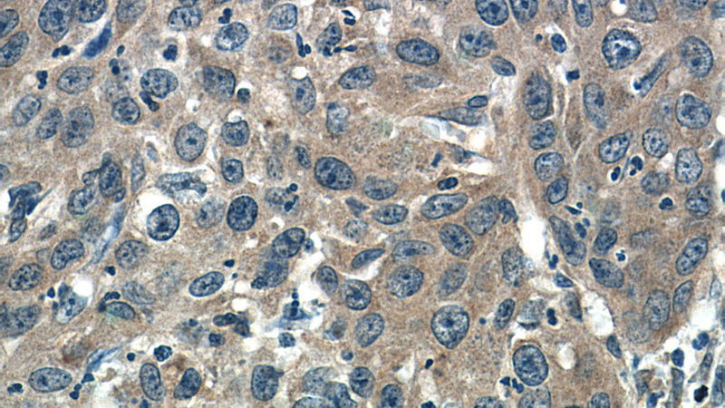 Immunohistochemistry of paraffin-embedded human cervical cancer tissue slide using Catalog No:107402(IL6 Antibody) at dilution of 1:50 (under 40x lens)