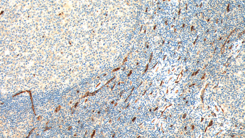 Immunohistochemistry of paraffin-embedded human tonsillitis tissue slide using Catalog No:107132(CD34 Antibody) at dilution of 1:800 (under 10x lens). heat mediated antigen retrieved with Tris-EDTA buffer(pH9).