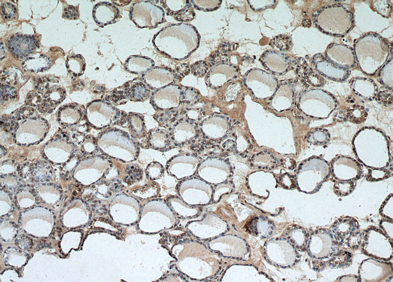Immunohistochemical of paraffin-embedded human thyroid using Catalog No:107455(PAX8-Specific antibody) at dilution of 1:50 (under 10x lens)
