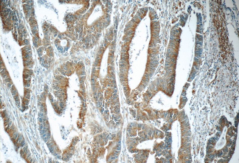 Immunohistochemistry of paraffin-embedded human colon cancer tissue slide using Catalog No:108785(C6orf70 Antibody) at dilution of 1:50 (under 10x lens)