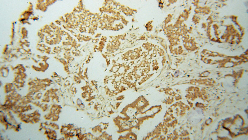 Immunohistochemical of paraffin-embedded human ovary tumor using Catalog No:114389(PSMC2 antibody) at dilution of 1:100 (under 10x lens)