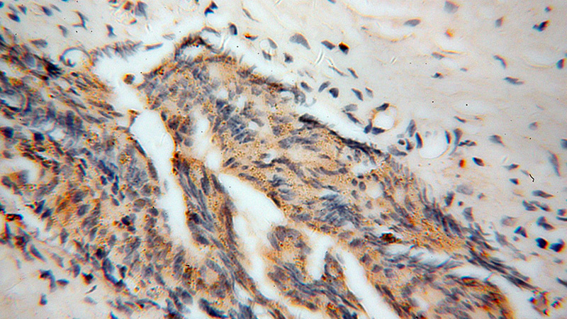Immunohistochemical of paraffin-embedded human gliomas using Catalog No:115083(SEC6 antibody) at dilution of 1:100 (under 40x lens)