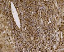 Fig4: Immunohistochemical analysis of paraffin- embedded human lung cancer tissue using anti-EFTUD2 Mouse mAb.