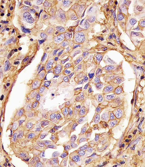169110 staining CD44 in human lung adenocarcinoma tissue sections by Immunohistochemistry (IHC-P - paraformaldehyde-fixed, paraffin-embedded sections). Tissue was fixed with formaldehyde and blocked with 3% BSA for 0. 5 hour at room temperature; antigen retrieval was by heat mediation with a citrate buffer (pH6). Samples were incubated with primary antibody (1/25) for 1 hours at 37°C. A undiluted biotinylated goat polyvalent antibody was used as the secondary antibody.