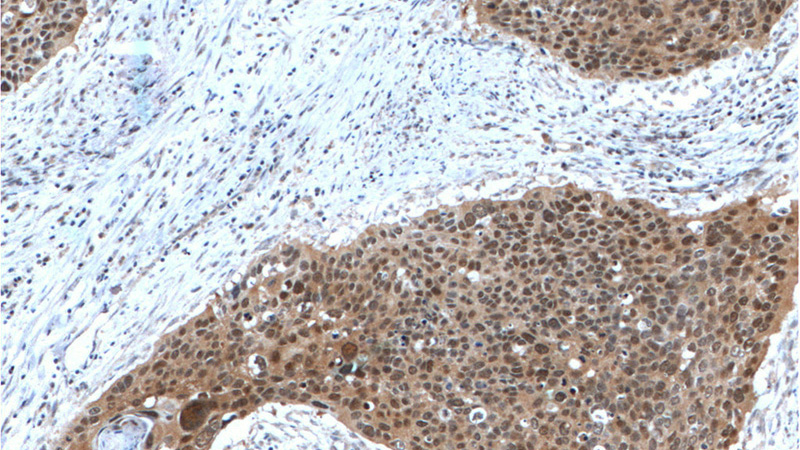 Immunohistochemistry of paraffin-embedded human cervical cancer tissue slide using Catalog No:107217(FKBP52 Antibody) at dilution of 1:200 (under 10x lens). Heat mediated antigen retrieved with Tris-EDTA buffer, pH9.0