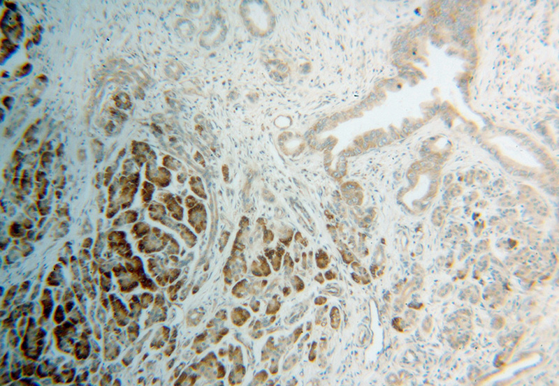 Immunohistochemical of paraffin-embedded human pancreas cancer using Catalog No:114908(SCAR antibody) at dilution of 1:100 (under 10x lens)