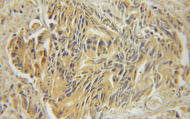Immunohistochemical of paraffin-embedded human prostate cancer using Catalog No:112449(Marcks antibody) at dilution of 1:200 (under 10x lens)