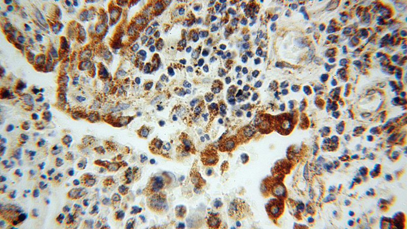 Immunohistochemical of paraffin-embedded human lung cancer using Catalog No:108355(ATP5H antibody) at dilution of 1:100 (under 40x lens)