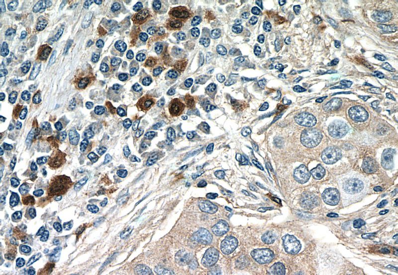 Immunohistochemistry of paraffin-embedded human breast cancer tissue slide using Catalog No:109641(CXCL17 Antibody) at dilution of 1:50 (under 40x lens)