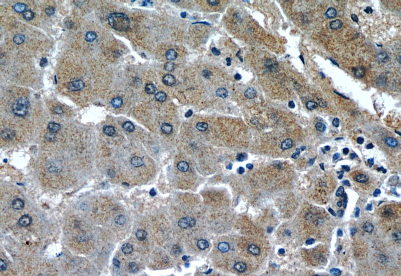 Immunohistochemistry of paraffin-embedded human hepatocirrhosis tissue slide using Catalog No:111566(SERPINH1 Antibody) at dilution of 1:50