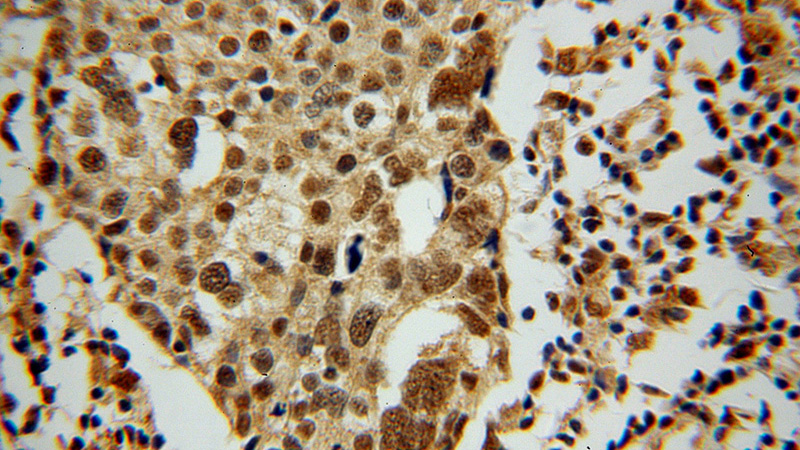 Immunohistochemical of paraffin-embedded human ovary tumor using Catalog No:112880(YBX2 antibody) at dilution of 1:50 (under 40x lens)