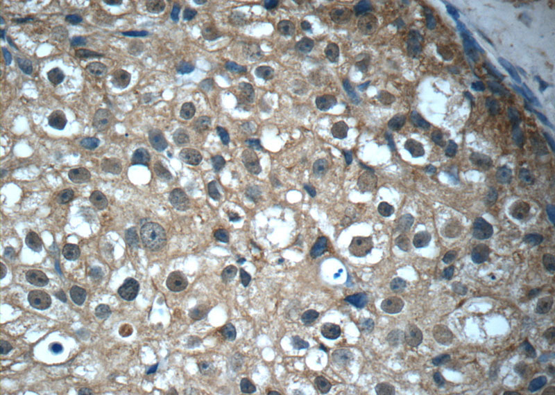 Immunohistochemistry of paraffin-embedded human breast cancer tissue slide using (BRCA1 Antibody) at dilution of 1:100 (under 40x lens)