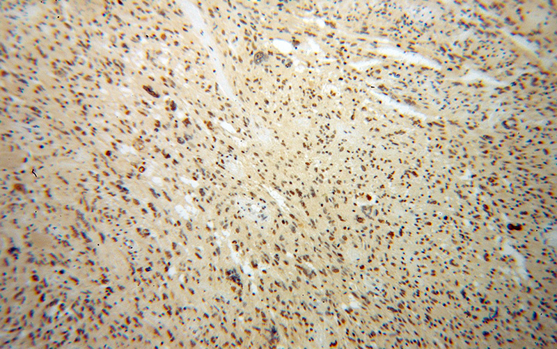 Immunohistochemical of paraffin-embedded human gliomas using Catalog No:113724(PES1 antibody) at dilution of 1:100 (under 10x lens)