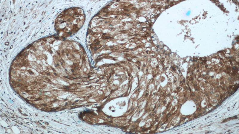 Immunohistochemistry of paraffin-embedded human breast cancer tissue slide using Catalog No:110749(FUT7 Antibody) at dilution of 1:50 (under 10x lens)