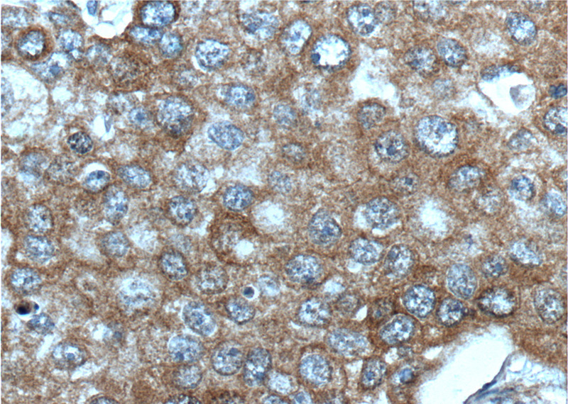 Immunohistochemistry of paraffin-embedded human breast cancer tissue slide using Catalog No:107280(IGF1R-Specific Antibody) at dilution of 1:200 (under 40x lens). heat mediated antigen retrieved with Tris-EDTA buffer(pH9).
