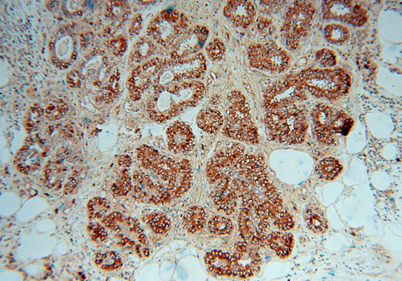 Immunohistochemical of paraffin-embedded human breast cancer using Catalog No:109724(CTHRC1 antibody) at dilution of 1:50 (under 10x lens)