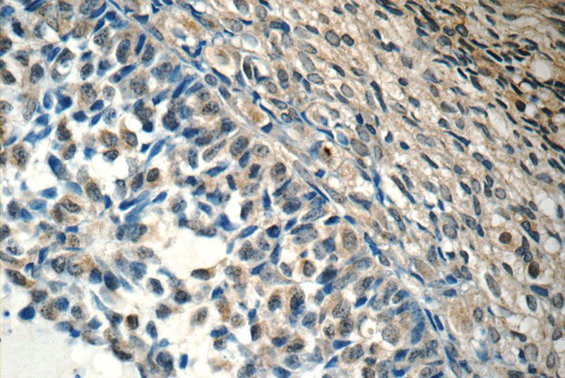 Immunohistochemistry of paraffin-embedded human ovary tissue slide using Catalog No:117017(ZNF654 Antibody) at dilution of 1:50 (under 40x lens)